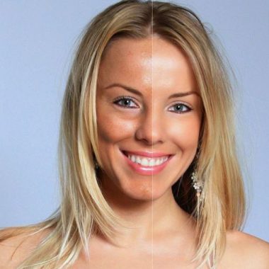 Metody usuwania przebarwień skórnych